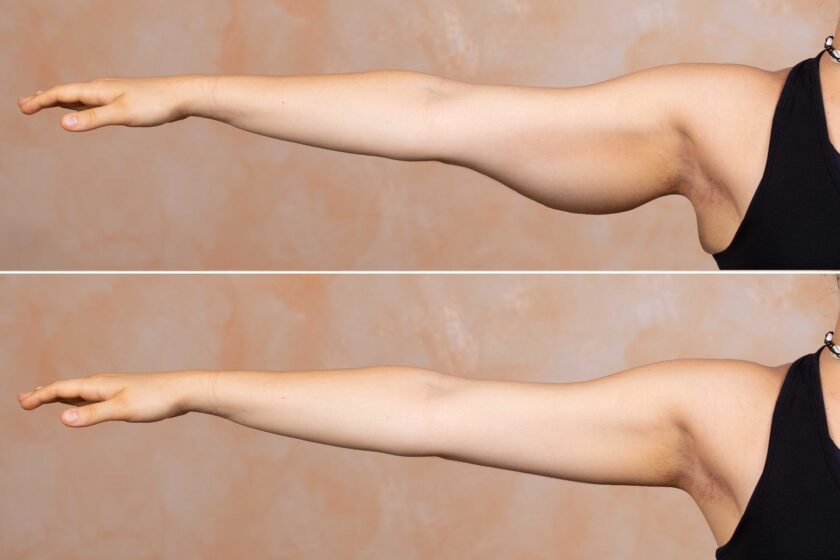 Sagging arm skin after weight loss