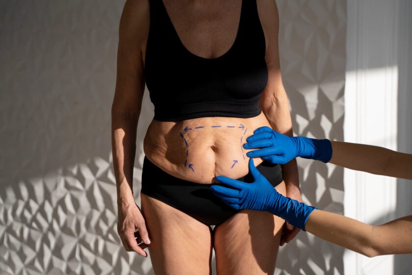 Sagging skin after weight loss