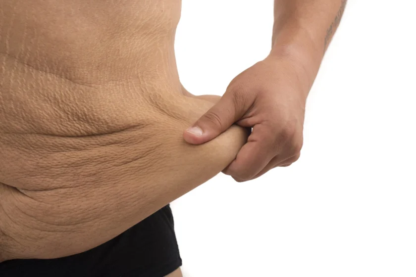 sagging skin after bariatric surgery