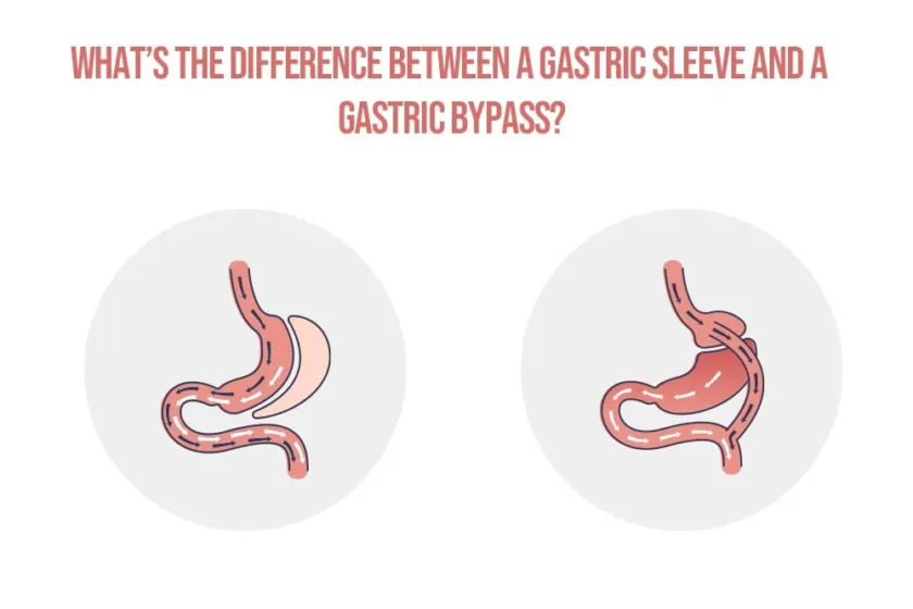 Whats the difference gastric sleeve and bypass