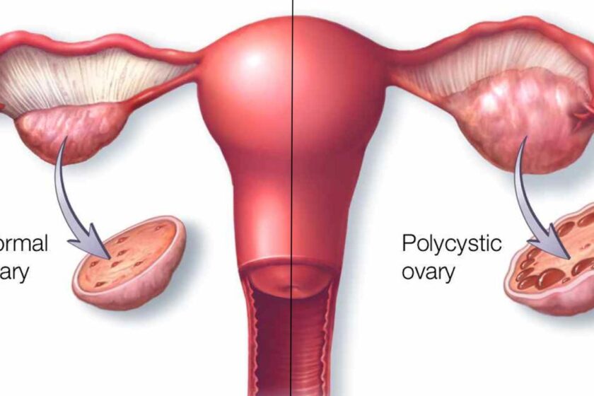 Bariatric Surgery for PCOS