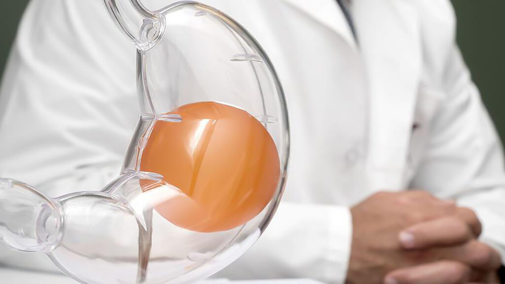 Get the Facts about Gastric Balloons: Your Key to Weight Loss Near You Get the Facts about Gastric Balloons: Your Key to Weight Loss Near You