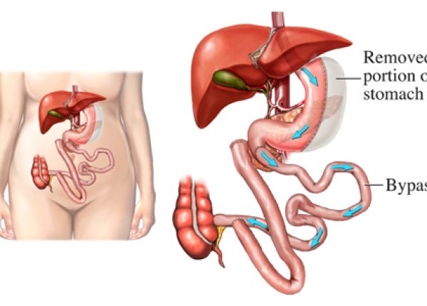 duodenal-switch-for-revisions