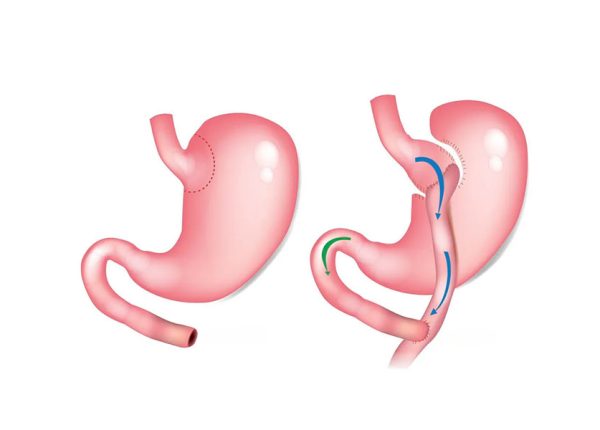 gastric-bypass