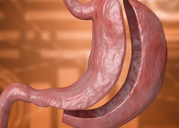 gastric-sleeve